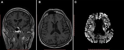 Bilingualism in a Case of the Non-fluent/agrammatic Variant of Primary Progressive Aphasia